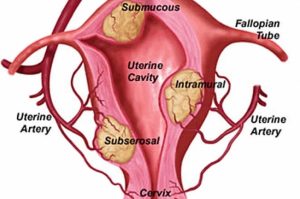 fibrom uterin - life balance